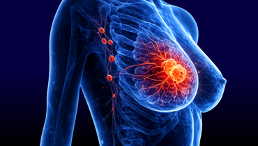 Kompleksowa diagnostyka obrazowa chorób piersi - Entomografia